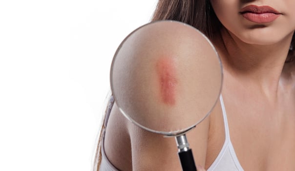 Woman having large hypertrophic scar on her right upper arm due to injury or vaccination photo