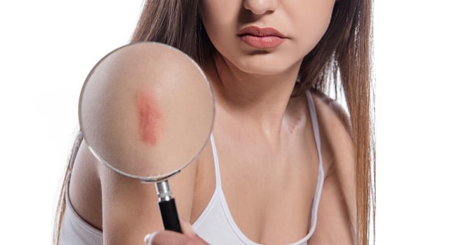 Woman having large hypertrophic scar on her right upper arm due to injury or vaccination photo