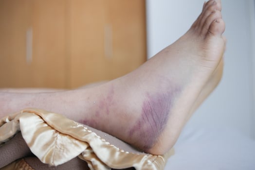 close up of women feet with swelling photo