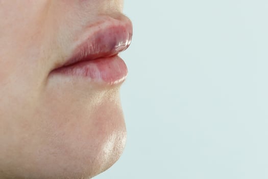 Treatment with botox or hyaluronic collagen HA injection photo