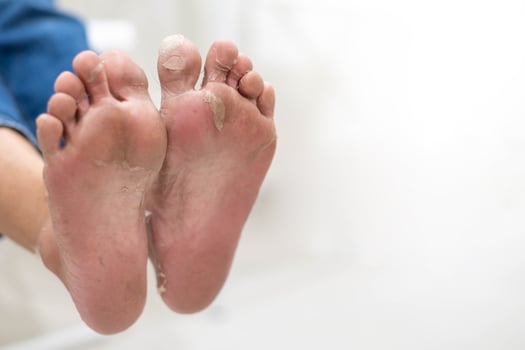 Close up of peeling off and cracked foot due to an allergic chemical reaction. photo