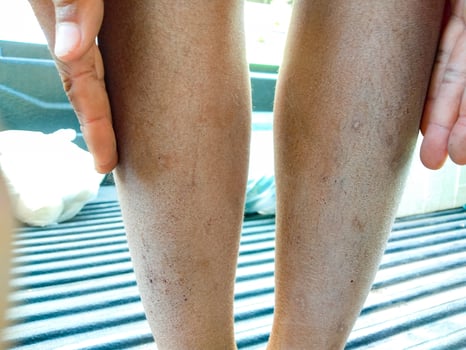 Baby leg, broken skin, dry, concept  Dermatitis, eczema, ringworm  cream lotion cosmetic photo