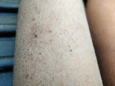 dry cracked skin concept  Dermatitis, eczema, ringworm  cream lotion cosmetic photo