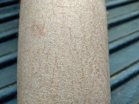 dry cracked skin concept  Dermatitis, eczema, ringworm  cream lotion cosmetic photo