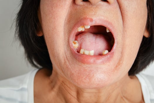 An elderly Asian woman smiled and saw the remaining teeth in the mouth. Due to partial loss resulting in the need to wear artificial teeth. The concept of good oral health photo