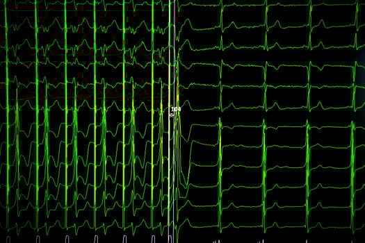 Medical background cardiogram on the monitor. photo