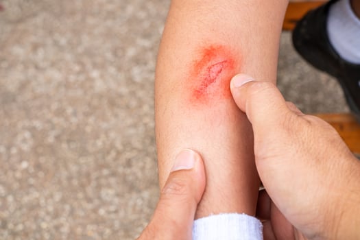 Father's hand holding baby's leg while injured leg ulcer caused by running fall, fresh wound on child's leg, health care concept photo