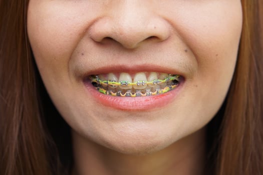 Asian women with disorganized braces photo