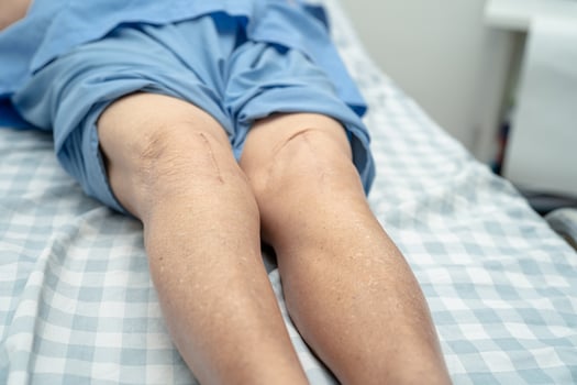 Asian senior or elderly old lady woman patient show her scars surgical total knee joint replacement Suture wound surgery arthroplasty on bed in nursing hospital ward, healthy strong medical concept. photo