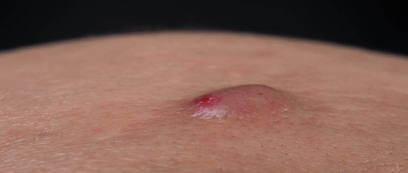 Big Acne Cyst Abscess or Ulcer Swollen area within face skin tissue. photo