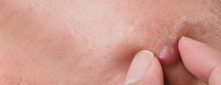 Big Acne Cyst Abscess or Ulcer Swollen area within face skin tissue. photo