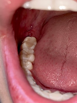Soft Focus. Sutures after wisdom tooth extraction, Dental surgery. Oral hygiene photo