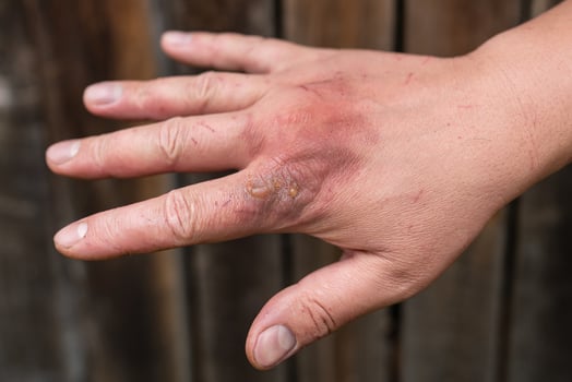 First degree skin burn. Hand burns, wounds. Hot boiling water acts on the skin. Fresh burn. photo