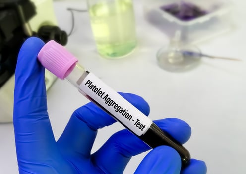 Blood sample for Plasma Viscosity test, Diagnosis for Polymyalgia rheumatica, giant cell arteritis or temporal arteritis, such as headaches, neck or shoulder pain, pelvic pain, joint stiffnes. photo