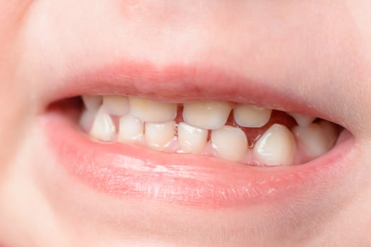Little baby's teeth are shot at the macro when she laughs photo