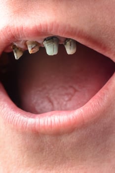 The woman opened her mouth wide, and showed her crooked and rotten teeth close up photo