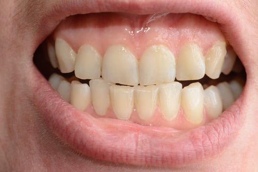 A young woman shows her crooked teeth that needs medical help in close-ups photo