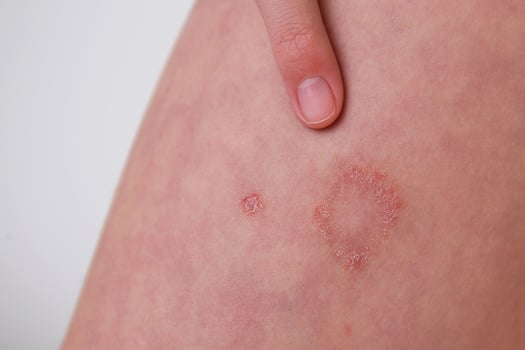 The child has allergic contact dermatitis on the skin. photo