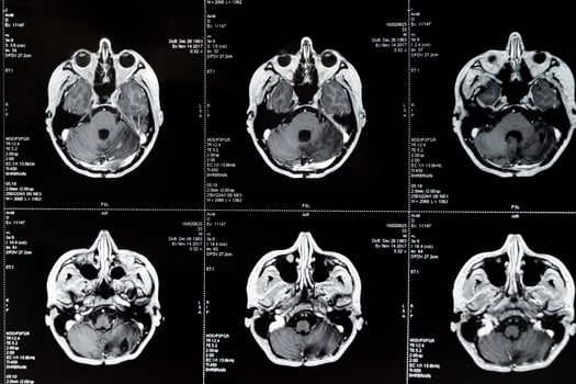 mri with brain tumor. Magnetic resonance imaging. photo
