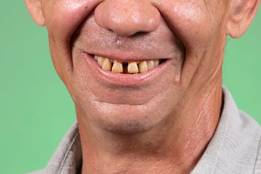 Part of the face with ugly yellow and sparse teeth. Dental problems of anterior teeth in an elderly person.Smiling mouth of a man with crooked yellow teeth close-up photo