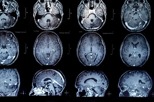 mri with brain tumor. Magnetic resonance imaging. photo