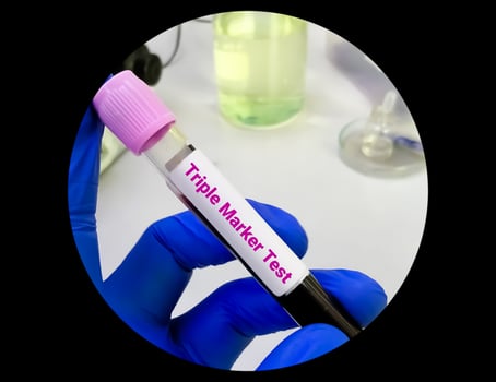 Blood Sample for Triple Marker Test. photo