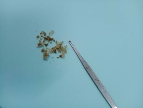Earwax, earwax, cotton swabs, on a light blue table photo