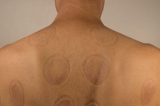 Mature man that had Cupping Therapy done on his back for pain relief photo