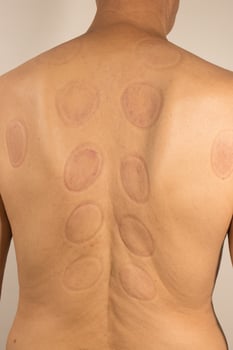 Mature man that had Cupping Therapy done on his back for pain relief photo