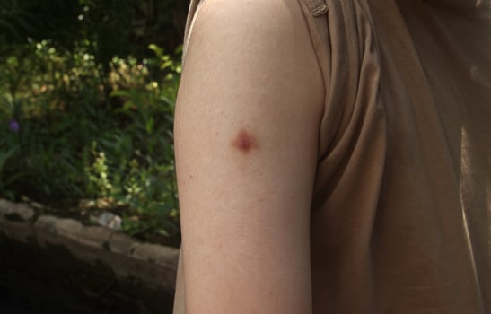 Small burn wound on human skin body, specifically human right arm. Male or woman skin problem, painful and need treatment but almost healing. Medical themed photo on dark background isolated.