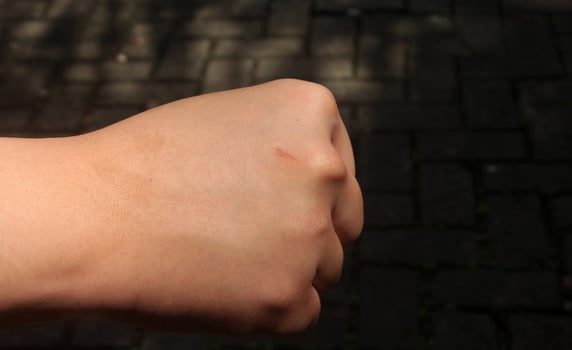 Small scar or wound on human skin body, specifically human right arm. Male or woman skin problem, painful and need treatment but almost healing. Medical themed photo on dark background isolated.