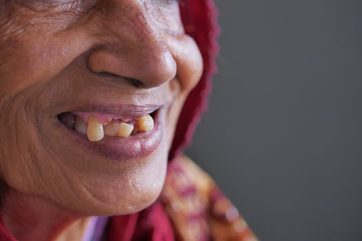 Senior Woman Smiling With Deformed Teeth. photo