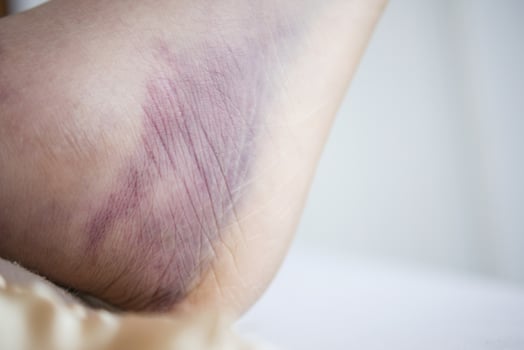 close up of women feet with swelling photo