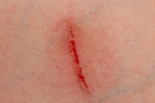 Close up a wound with blood on the skin photo