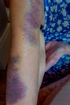 the hand of an elderly woman with bruises photo