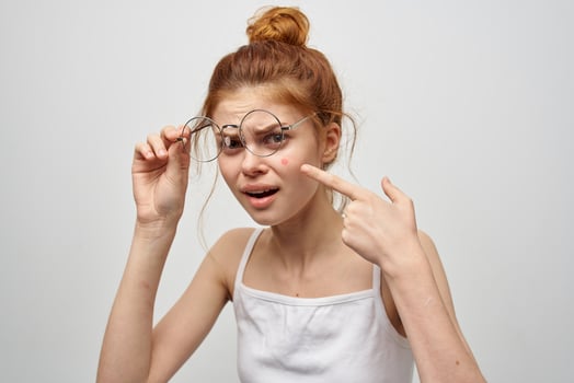 woman face with pimple skin problems close-up photo