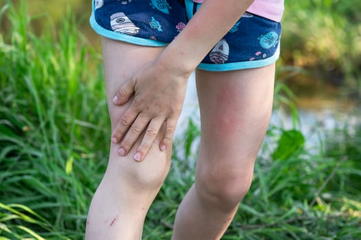 Girl sprays mosquito spray on the skin in nature that bite her hands and feet. Protection from insect bites, repellent safe for children. Outdoor recreation, against allergies. Summer time photo