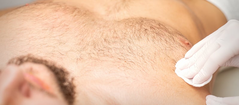 Young caucasian man receiving hair removal from his chest in a beauty salon, depilation men's torso. photo