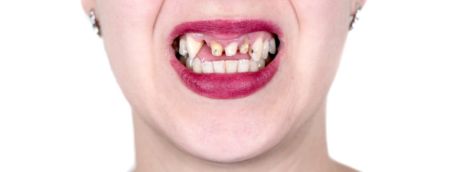 Smile of woman without front teeth photo