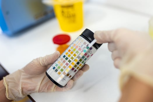 Reagent Strip for Urinalysis , Routine Urinalysis, check-up analysis in laboratory. Medical report and urine test strips photo