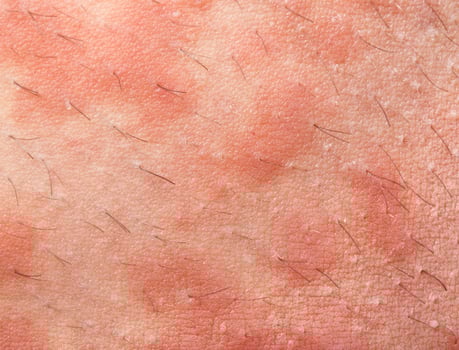 Eczema atopic dermatitis photo