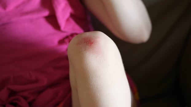 Wounded knee of the child, abrasions on the baby girl's knees. photo
