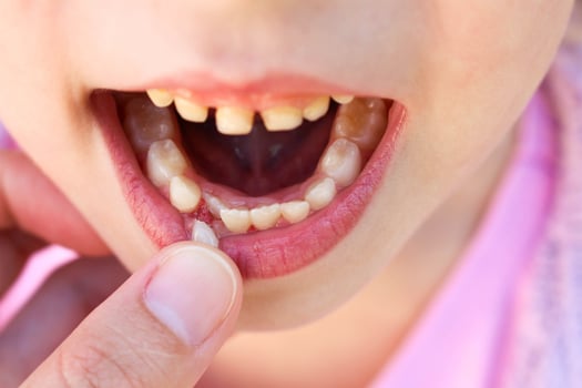 At 6 years old child loose tooth photo