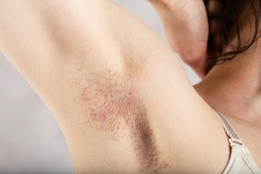 Three days after needle epilation in armpit zone. photo
