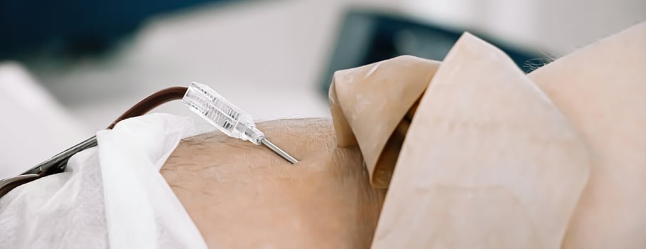 Catheter in vein close-up. International Blood Donation Day. photo