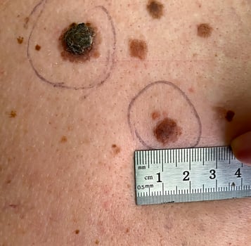 Measuring the size of a mole on human skin. photo