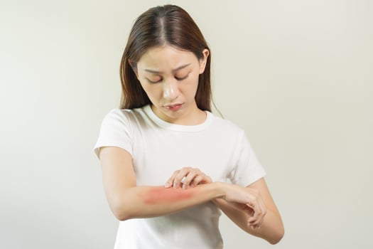 Dermatology asian young woman, girl allergy, allergic reaction from atopic, insect bites on her arm, hand in scratching itchy, itch red spot or rash of skin. Healthcare, treatment of beauty. photo