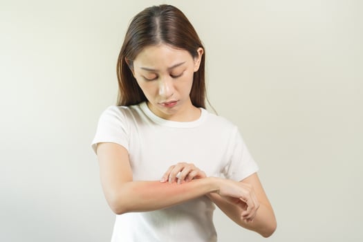 Dermatology asian young woman, girl allergy, allergic reaction from atopic, insect bites on her arm, hand in scratching itchy, itch red spot or rash of skin. Healthcare, treatment of beauty. photo