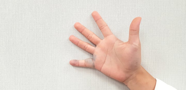 Man's hand has varicose veins in his right finger and swollen or inflamed isolated on white wallpaper wall. Body of human part and Healthcare or therapy concept. photo