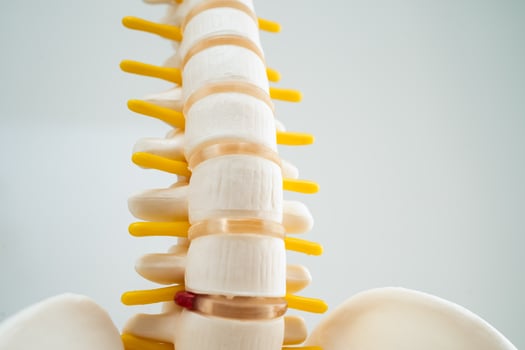 Lumbar spine displaced herniated disc fragment, spinal nerve and bone. Model for treatment medical in the orthopedic department. photo